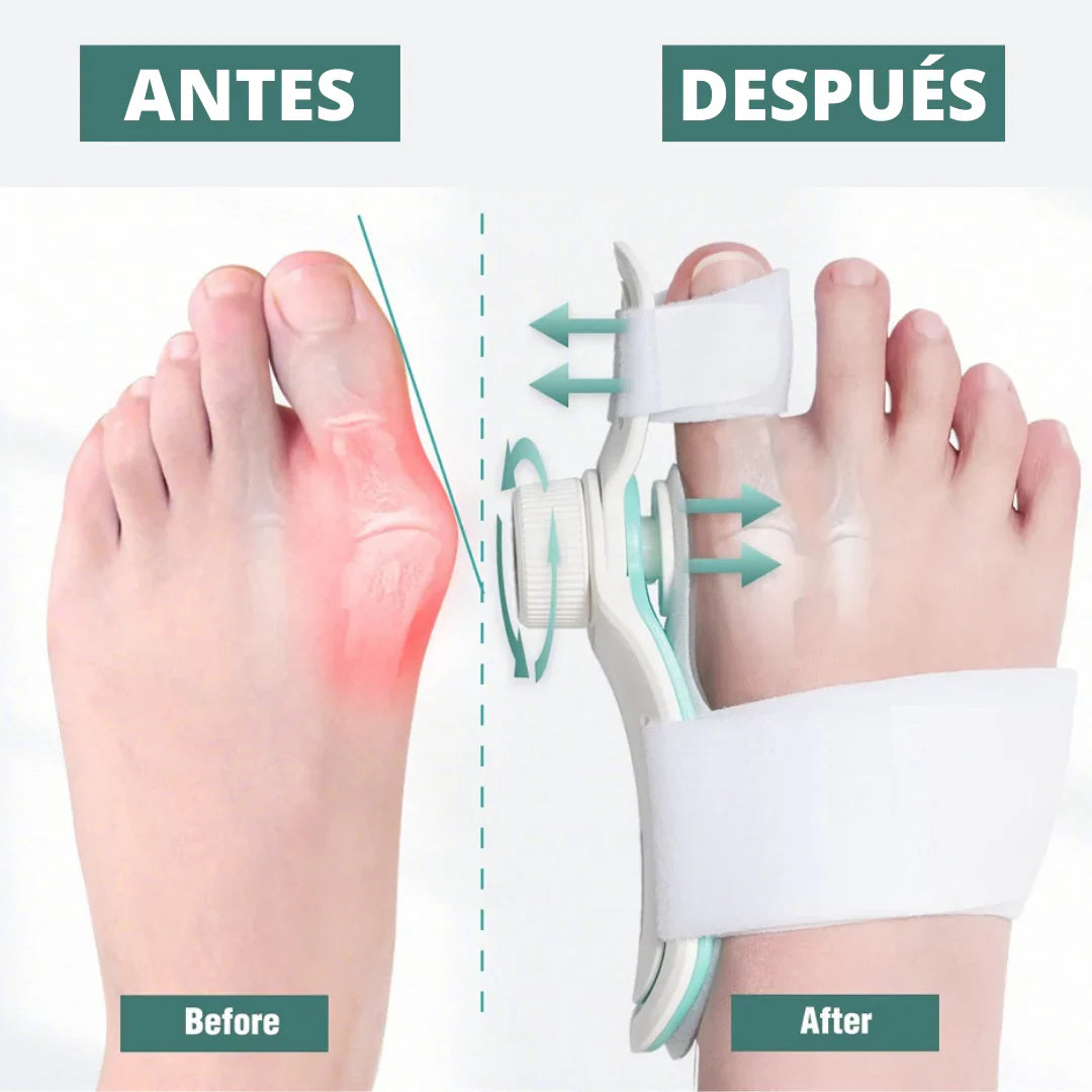 StepBalance™ — Corrector de Juanetes Comfort Plus para Alineación Natural del Pie