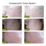 Lápiz Láser Para Acné, Disminución De Arrugas y Cicatrices Suaves