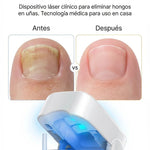 Dermolux® (Dispositivo láser para tratamiento de hongos en las uñas)